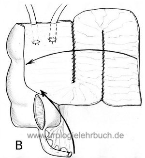 Detubularisation Harnleiterimplantation MAINZ Pouch 1 Harnableitung nach Zystektomie Harnblasenkarzinom