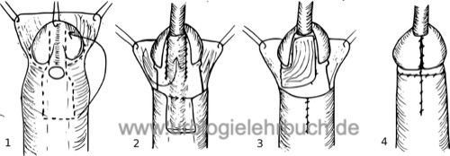 Hypospadie Operation nach Mathieu Hautlappen