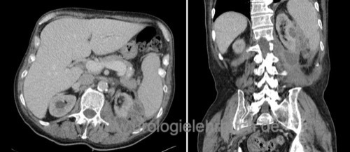 CT Abdomen bei linksseitigem Nierenabszess mehrfach gekammert Lufteinschlüsse