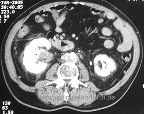 CT Abdomen Nierenbeckenkarzinom Harnleiterkarzinom Urothelkarzinom