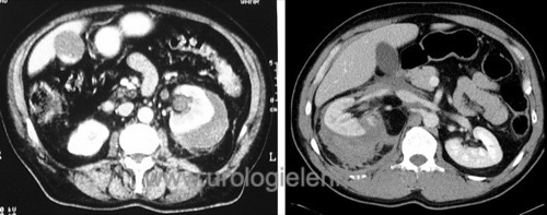 Nierentrauma retroperitoneales Hämatom CT Computertomographie Hämatom Urinom