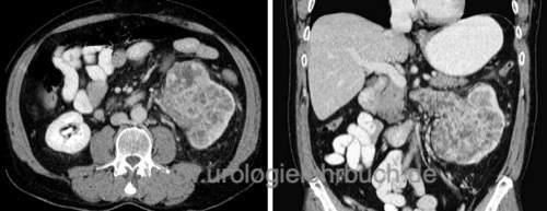 CT-Abdomen bei Nierenzellkarzinom pT3b Nierenzellkarzinom.