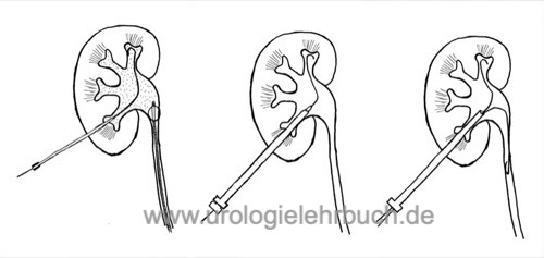 Nephrostomie sonographisch gesteuerte Punktion des dorsalen unteren Kelches mit einer Hohlnadel. Arbeitsdraht in die obere Kelchgruppe oder in den Harnleiter. PCN Ballon-Ureterkatheters. Aufbougierung entlang des Arbeitsdrahtes mit einem Metallbougie Zwilling