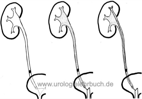 Retrograde Pyelographie Harnleiterstein Ureterkatheter jodhaltig kontrastmittel