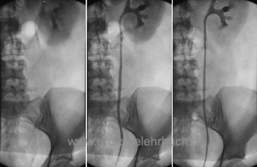 retrograde Pyelographie Harnleiterstein