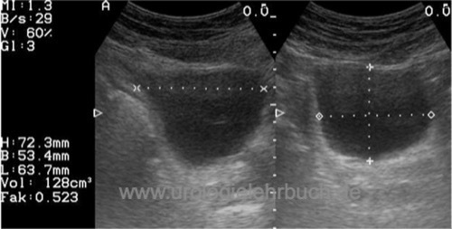 Sonographie Restharnmessung Harnblase