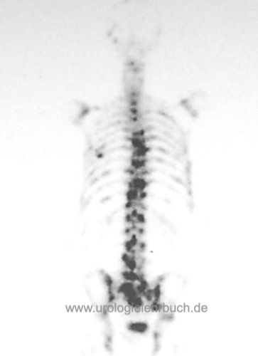 Knochenszintigraphie bei Prostatakarzinom mit einem PSA von 100 ng/ml: Nachweis von multiplen suspekten Herden in Brust- und Lendenwirbelsäule