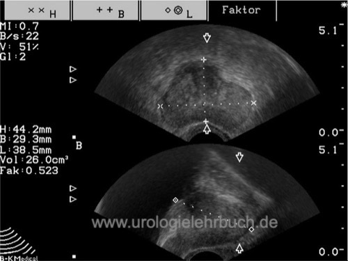 Transrektaler Ultraschall der Prostata (TRUS): Messung des Prostatavolumens mit einer 3-Punkt-Messung