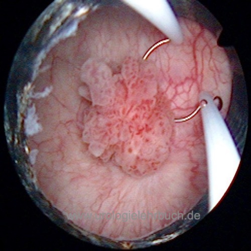 TURB transurethrale Resektion der Harnblase Resektionsschlinge papillär Harnblasenkarzinom