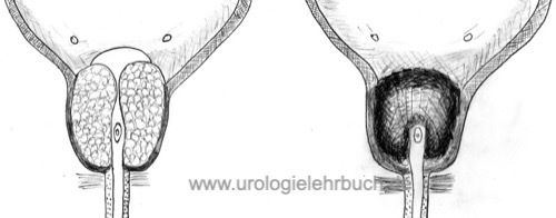 Abbildung Prinzip der TURP (transurethrale Resektion der Prostata)