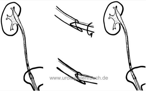 Ureterorenoskopie URS retrograde Pyelographie Harnleiterstein Dilatation URS