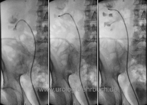 flexible ureterorenoskopie