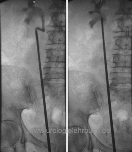 Ureterorenoskopie URS Harnleiterkinking