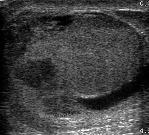 Ultraschall (Sonographie) einer Hodenruptur durch Verletzung des Hodens