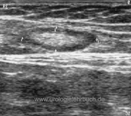 Abbildung Sonographie eines vergrößerten Leistenlymphknoten: typisches Bild einer benignen Lymphknotenvergrößerung (Länge 20 mm) mit regelmäßig ovalförmigen Lymphknoten und echogenem Zentrum als Zeichen der Verfettung.