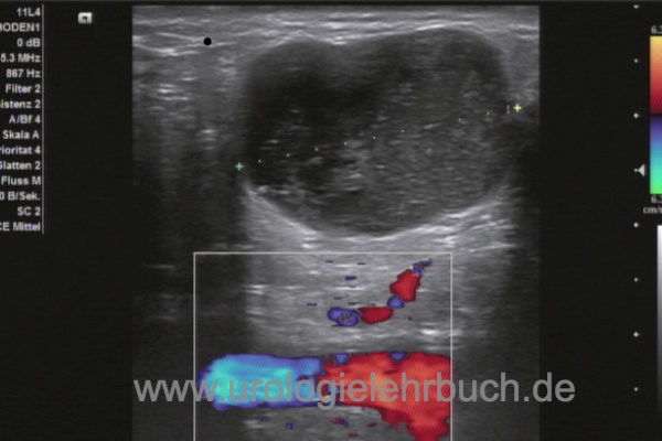 Abbildung Sonographie eines vergrößerten Leistenlymphknoten:> typisches Bild einer malignen Lymphknotenvergrößerung