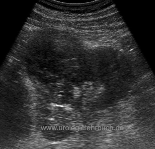 Sonographie der Niere: Nierenzellkarzinom (pT1)