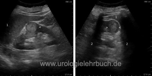 Sonographie der Niere: kleines peripher wachsendes Nierenzellkarzinom 