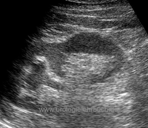 Doppelsystem der Niere Sonographie Ureter duplex