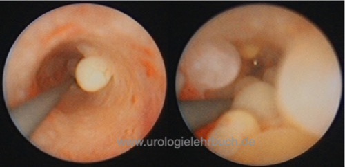 Abbildung Ureteritis cystica in der Ureterorenoskopie
