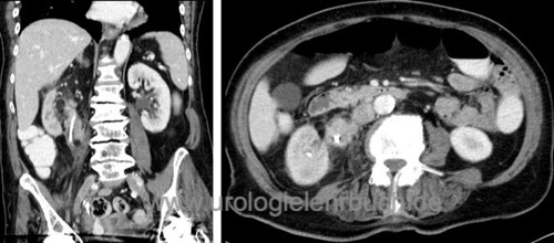 Nierenbeckenkarzinom CT Abdomen Ureterkarzinom Harnleiterkarzinom Urothelkarzinom