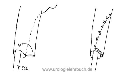 Uretermodellage nach Kalicinski Megaureter Ureterozystoneostomie Operation