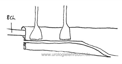 Uretermodellage mit Resektion Megaureter Ureterozystoneostomie Operation