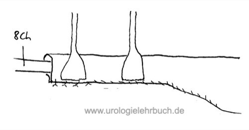 Uretermodellage mit Resektion Megaureter Ureterozystoneostomie Operation