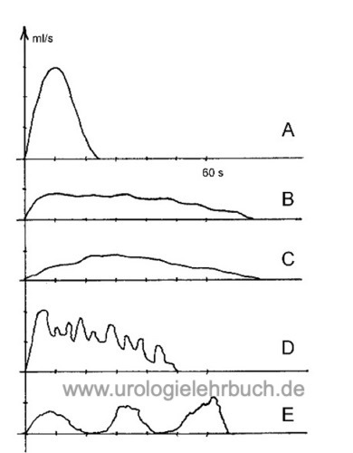 Differentialdiagnose von Uroflow-Kurven (Harnstrahlmessung)