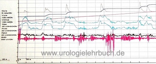 Kurvenverlauf einer Urodynamik (Harnblasendruckmessung, Zystometrie) einer autonomen Harnblase