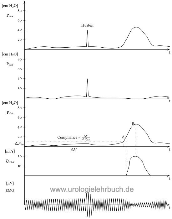 Normalbefund der Zystometrie Urodynamik Kurvenverlauf