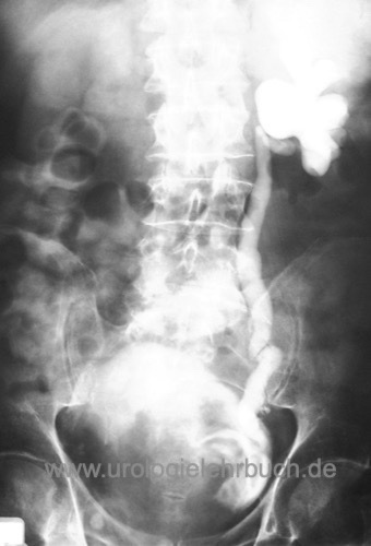 Harnblasenkarzinom Ausscheidungsurogramm Staging Blasenkrebs Urogramm