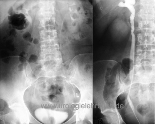 Abbildung Ureterozele im Urogramm und in der retrograden Pyelographie