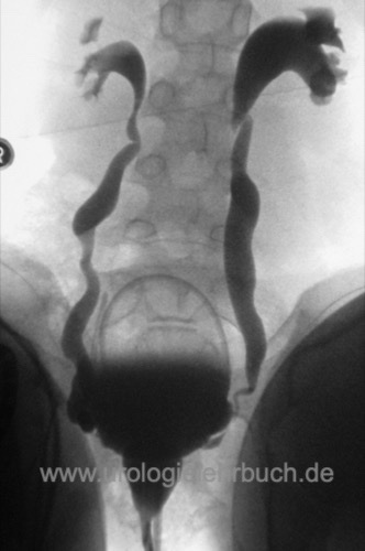 Abbildung MCU und Urodynamik bei vesikoureteralen Reflux Grad 3 VUR Miktionscysturethrogramm