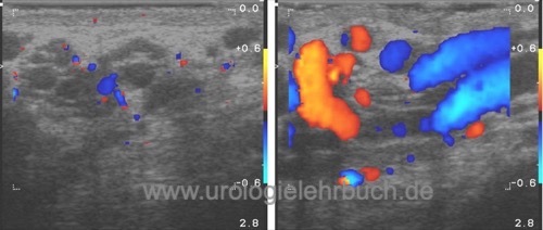 Abbildung Varikozele testis Sonographie der Krampfader des Hodens mit Farbdoppler.