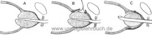 Abbildung Prinzip der retropubischen Prostata-Adenomektomie nach Millin zur Therapie der BPH