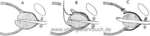 Abbildung Prinzip der transvesikalen Prostata-Adenomektomie nach Harris-Hryntschak zur Therapie der BPH