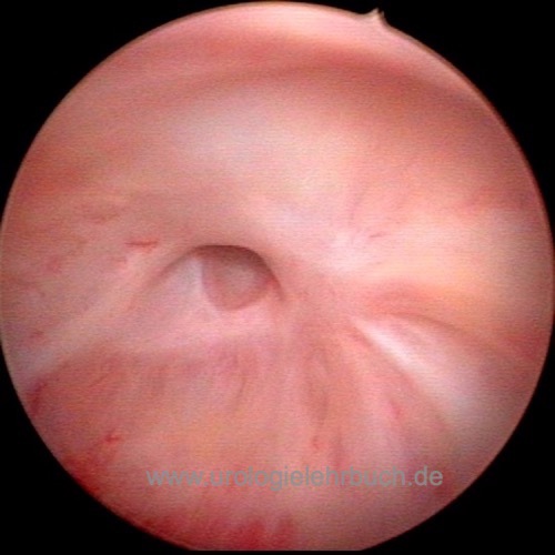 Abb. Zystoskopie einer Anastomosenstriktur nach radikaler Prostatektomie