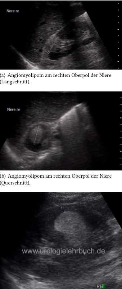 Abbildunge Angiomyolipom Nierentumor Sonographie