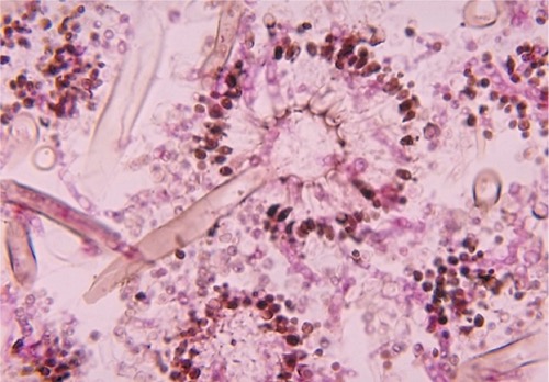 Aspergillus Mikroskopie sporenbildende Schimmelpilze Konidien Sporenköpfe Harnwegsinfektion