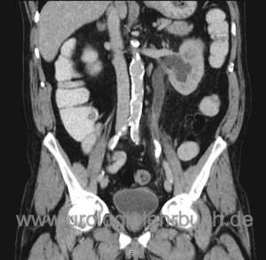 Abbildung Harnleiterstein im CT als Ursache von heftigen Bauchschmerzen (Nierenkolik)
