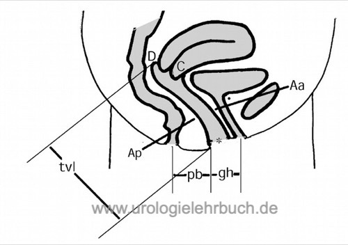 Schweregrad der Beckenbodensenkung (Beckenbodendeszensus) nach ICS