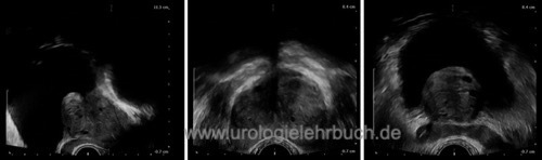 Abbildung Benigne Prostatahyperplasie mit vergrößertem Mittellappen und vereinzelt kleinen Zysten in der transrektalen Sonographie: