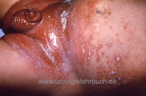 Candida Dermatitis Windel-Dermatitis