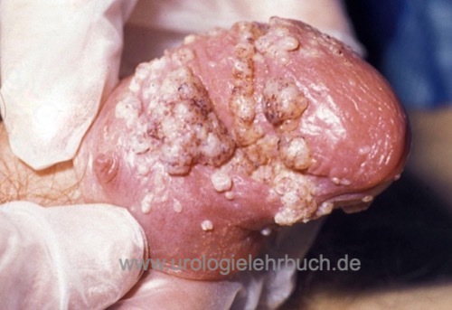 Condyloma acuminatum behandlung. Genital Warts (Condylomata Acuminata) papillomas sti