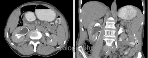 Abbildung CT Abdomen mit Fornixruptur