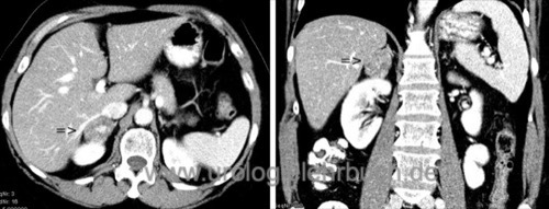 Abbildung CT Abdomen eines Inzidentaloms