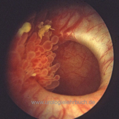 Abbildung Zystoskopischer Befund eines Blasendivertikels mit Harnblasenkarzinom