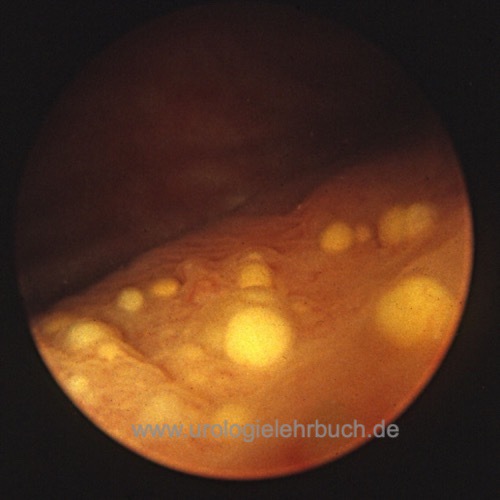 Zystoskopie: Cystitis cystica Zystoskopie: Cystitis cystica