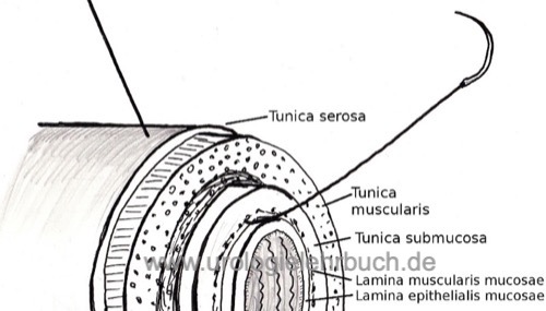 Abb. Anatomie der Darmwand und seromuskuläre Darmanastomose